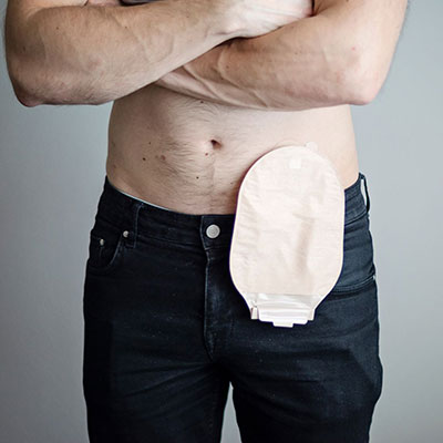 Ostomy-Care-Revolution - Stomagienics